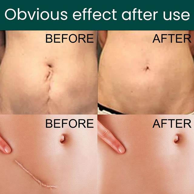 Silicone Scar Sheets for Scars, Acne & Wrinkles – Clinically Proven