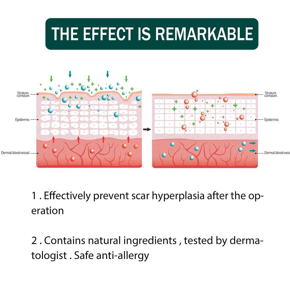 Silicone Scar Sheets for Scars, Acne & Wrinkles – Clinically Proven