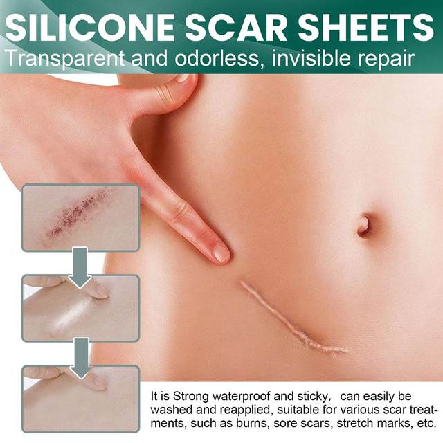 Silicone Scar Sheets for Scars, Acne & Wrinkles – Clinically Proven