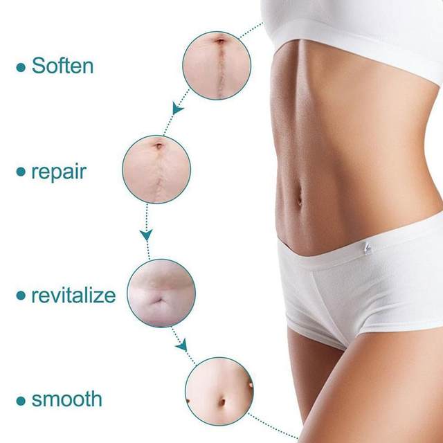 Silicone Scar Sheets for Scars, Acne & Wrinkles – Clinically Proven